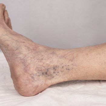 7 Things to Know About Sclerotherapy