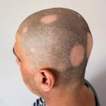 Alopecia-Areata-in-Abu-Dhabi