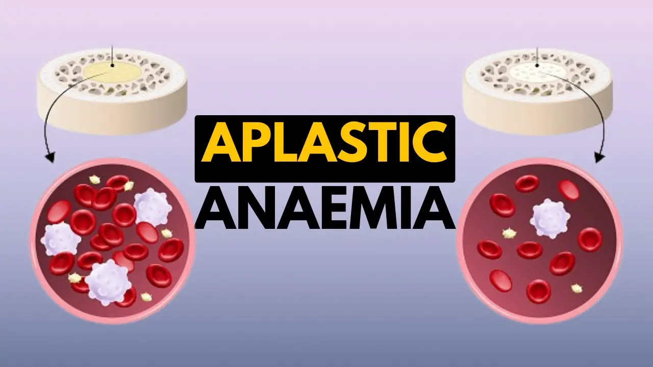 Anemia Disease Diagnostic and Treatment