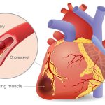 Can high blood pressure at a young age cause heart failure