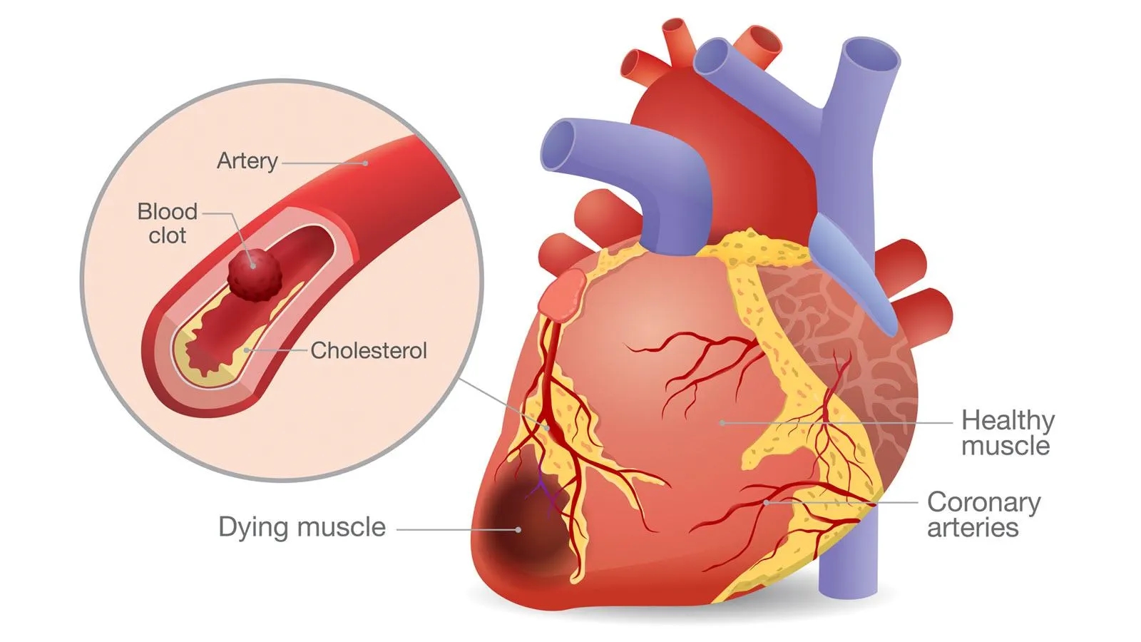 Can high blood pressure at a young age cause heart failure