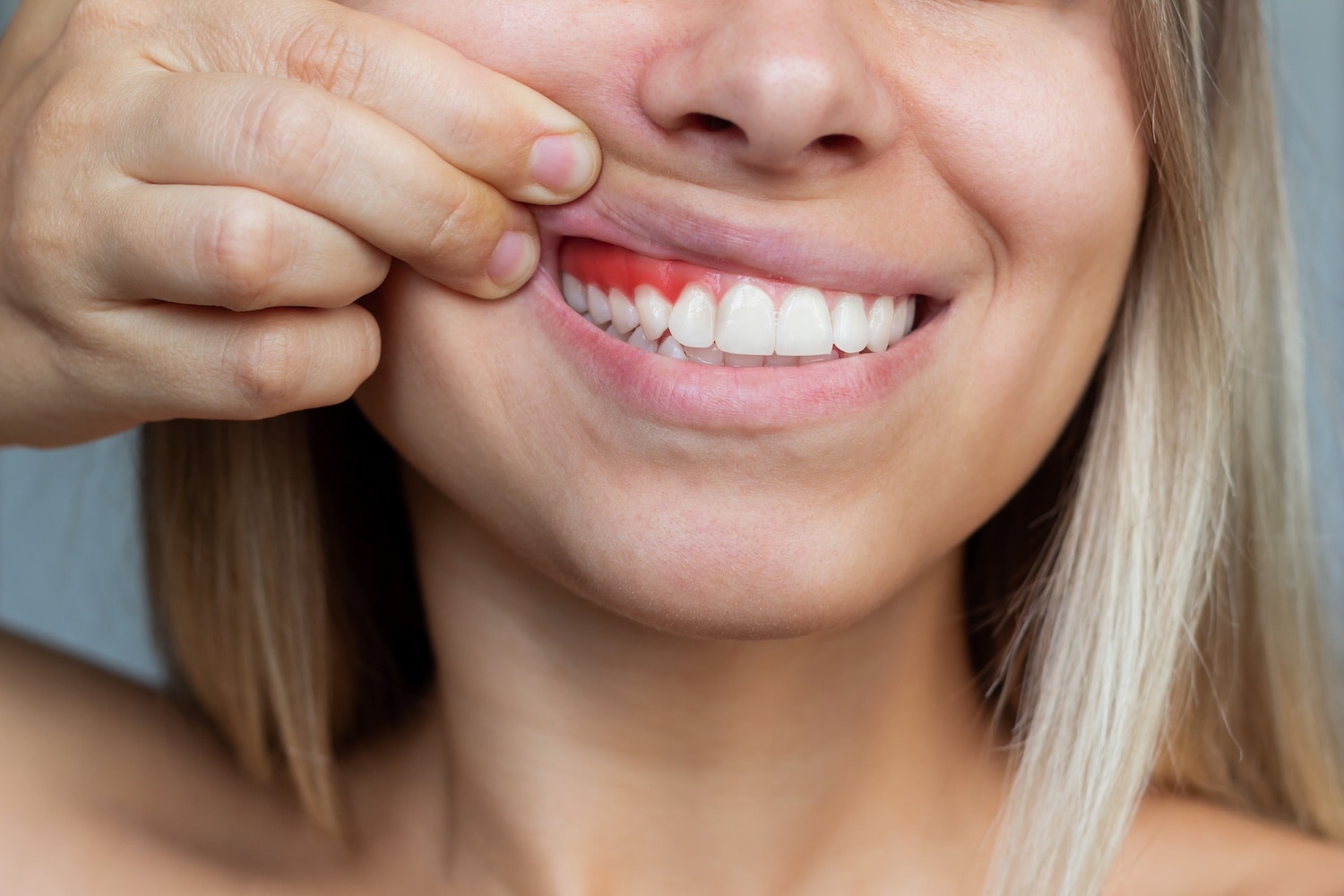 Everything You Need to Know About Periodontitis