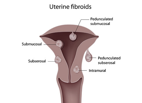Fibroid Removal Surgery