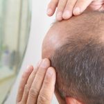 Stem Cell Fue Hair Transplant Dubai17