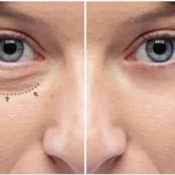 What age is good for eyelid surgery