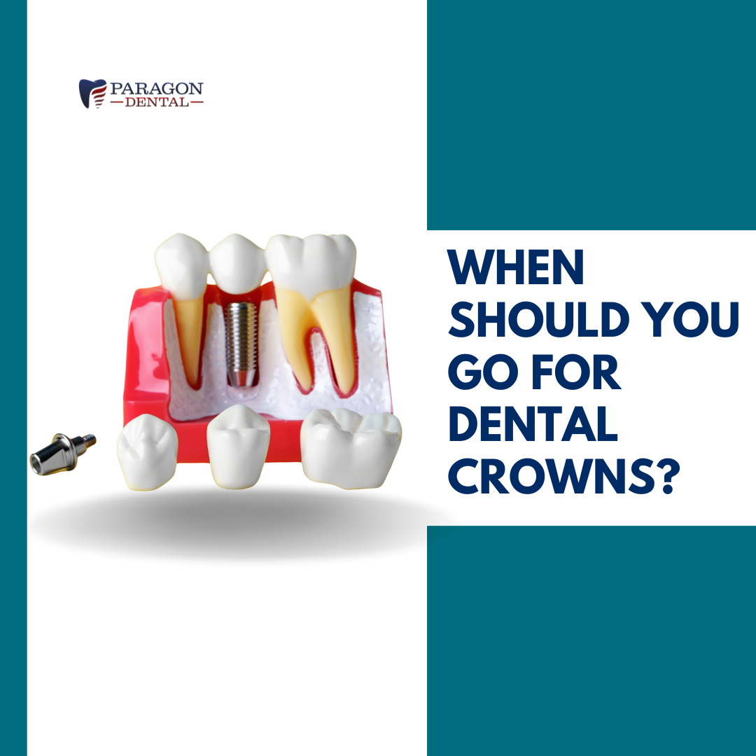 When-Should-You-Go-For-Dental-Crowns