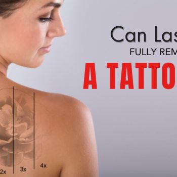 can-Laser-fully-remove-tattoo