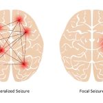 identifying-seizures