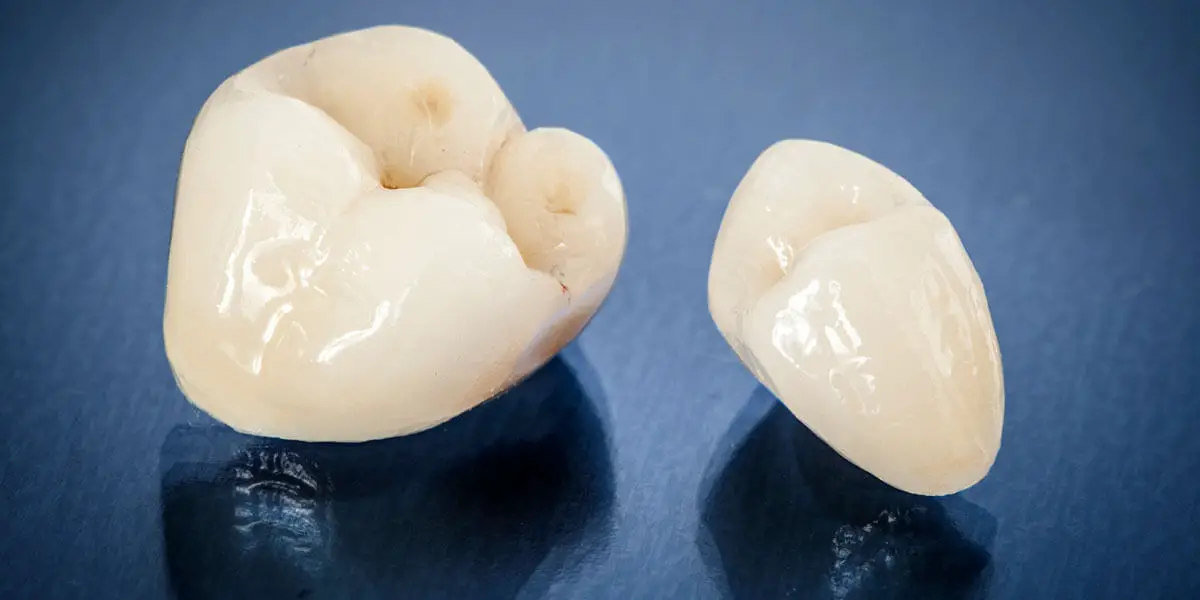 7 Steps to Do If Your Dental Crown Falls Off
