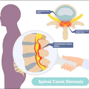Spinal Stenosis Treatment