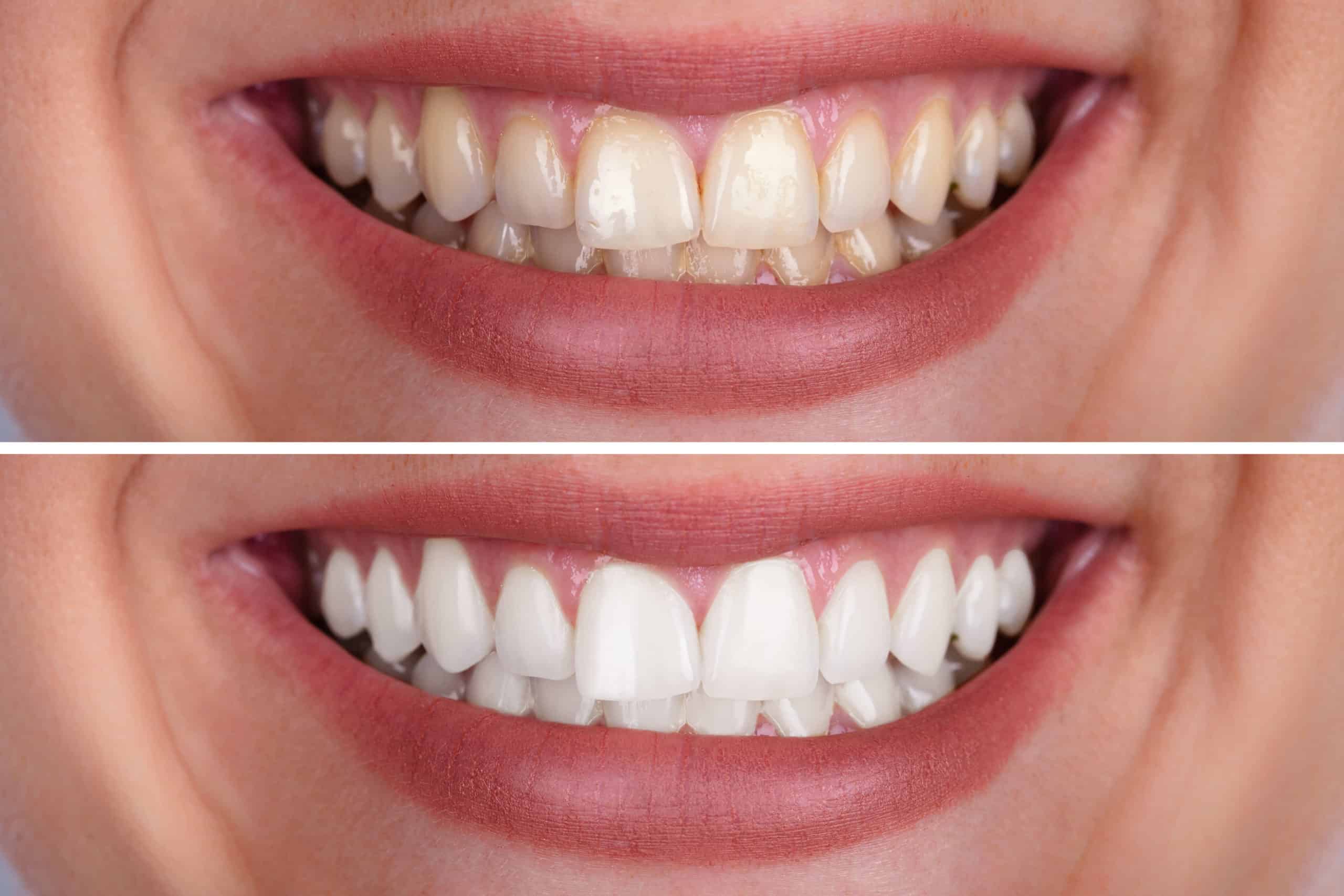 Teeth Whitening vs Teeth Bleaching