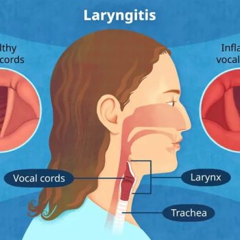 Laryngitis or Hoarseness of Voice