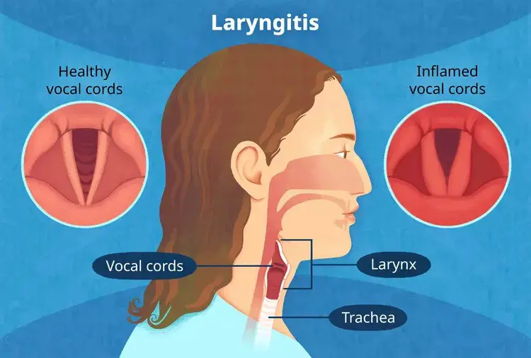 Laryngitis or Hoarseness of Voice