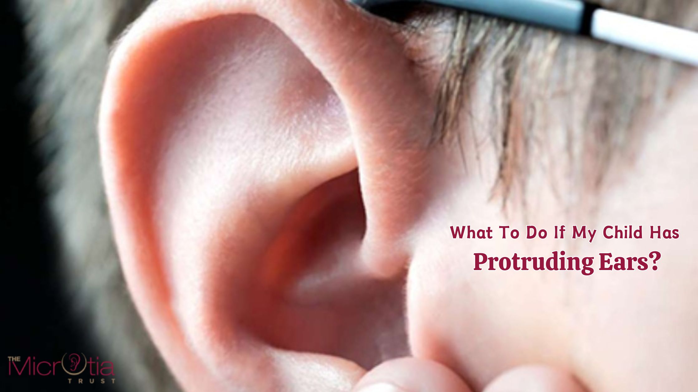 What To Do If My Child Has Protruding Ears