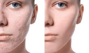 acne scarring laser treatment