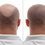 best fue hair transplant in bangalore,
