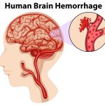 diagram-human-brain-hemorrhage_1308-73220