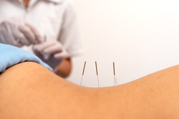 dry needling physical therapy