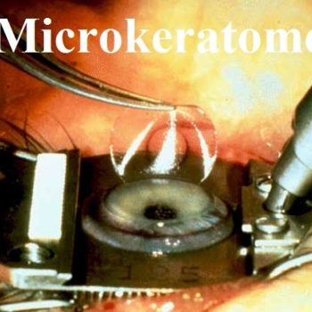 Microkeratome