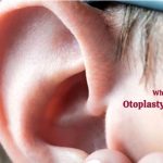 Who can get Otoplasty Ear Surgery