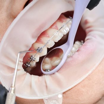 dentist-attaching-metal-braces-patient-teeth