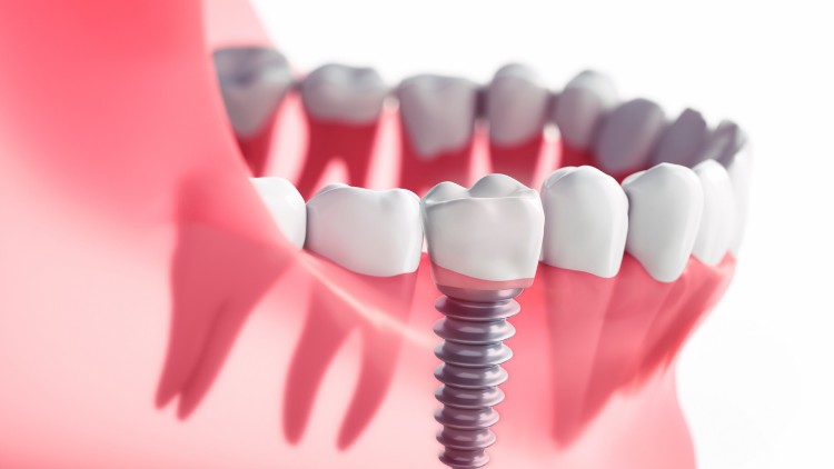 how-long-does-a-dental-implant-procedure-take-from-start-to-finish-balog-DDS-Monroe-Michigan-750px-1-1