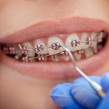 Braces-Treatment