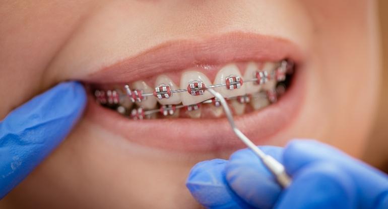 Braces-Treatment