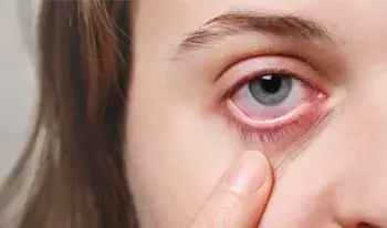 Dry-Eye-Syndrome_-Causes-Symptoms-and-Relief-Options