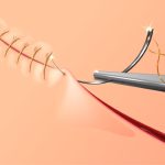 Japan Surgical Sutures Market