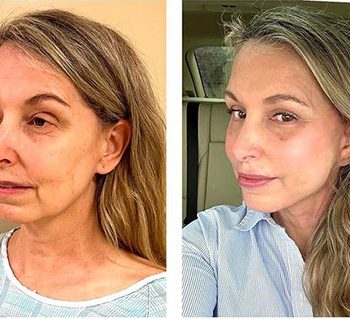 deep-plane-facelift-before-and-after