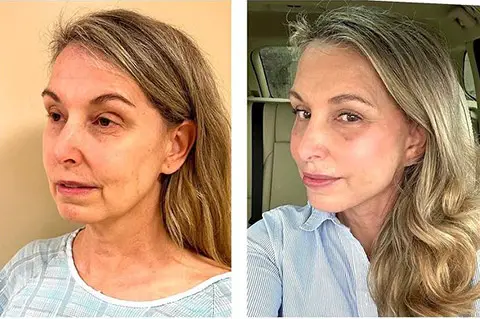 deep-plane-facelift-before-and-after