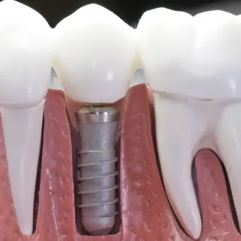7 Things To Know Before Getting Dental Implants
