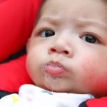 Comparing drool rash and eczema1