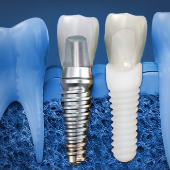 Dental-Implants-Strathfield