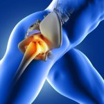 Hip Replacement Market Report