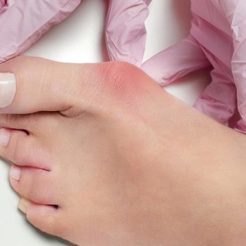 Top 5 Effective Treatment Options for Bunions