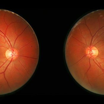 Retinal Disease Therapeutics Market Trends: Size and Share Analysis