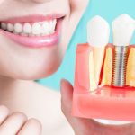 what-happens-during-a-dental-implant-procedure-and-how-much-does-it-cost-L