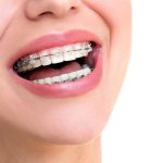 8 Facts About Orthodontic Treatment