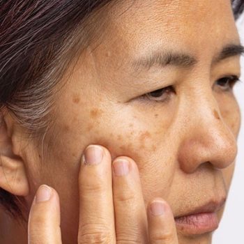 Best-Melasma-Treatment-in-Dubai-Abu-Dhabi-Sharjah-Cost-Deals