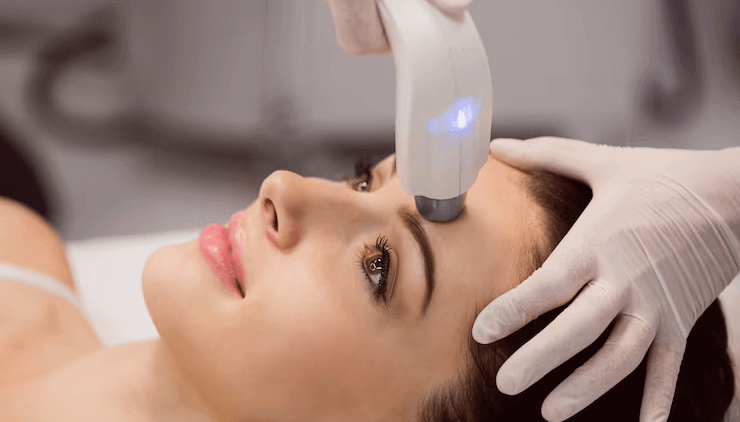 Fractional Laser for Stretch Marks