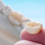 celina-dental-crowns-1536x1024