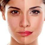 cost of Dermal Pigmentation in Dubai uae