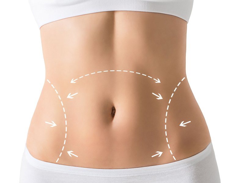 Circumferential Abdominoplasty in Dubai uae