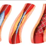 Drug-Eluting Stents Market