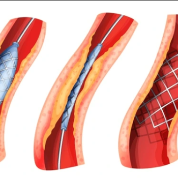 Drug-Eluting Stents Market