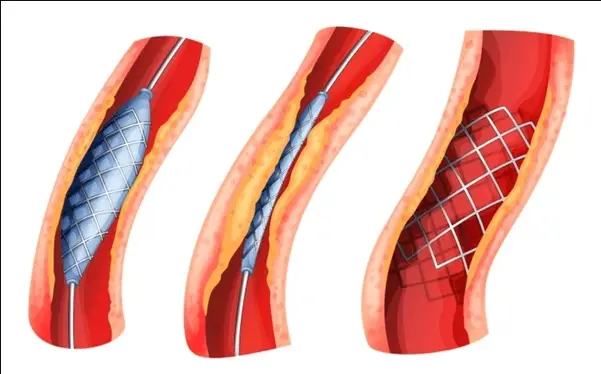 Drug-Eluting Stents Market