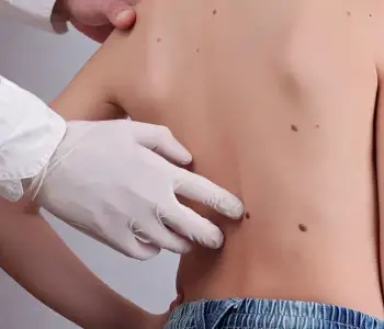 Mole Removal in Dubai