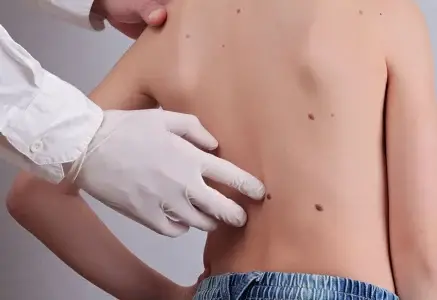 Mole Removal in Dubai